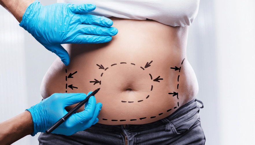Cambios en la dieta después de una cirugía bariátrica: claves de nutrición y recuperación - Hi Vitamins